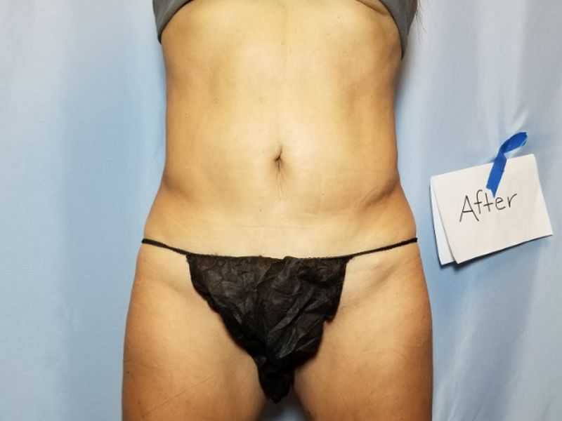 after weight loss