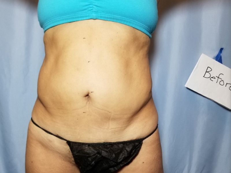 before weight loss