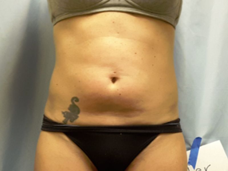 after weight loss