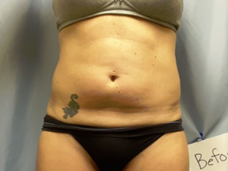 before weight loss