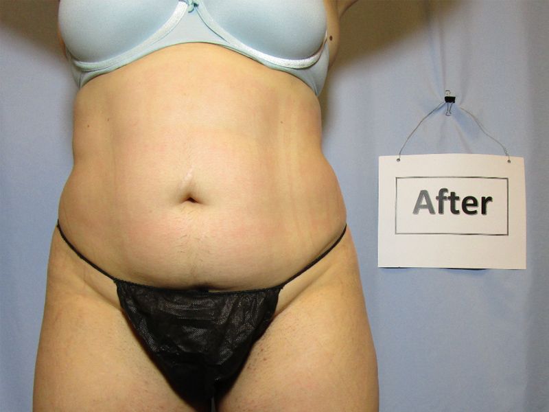 after weight loss