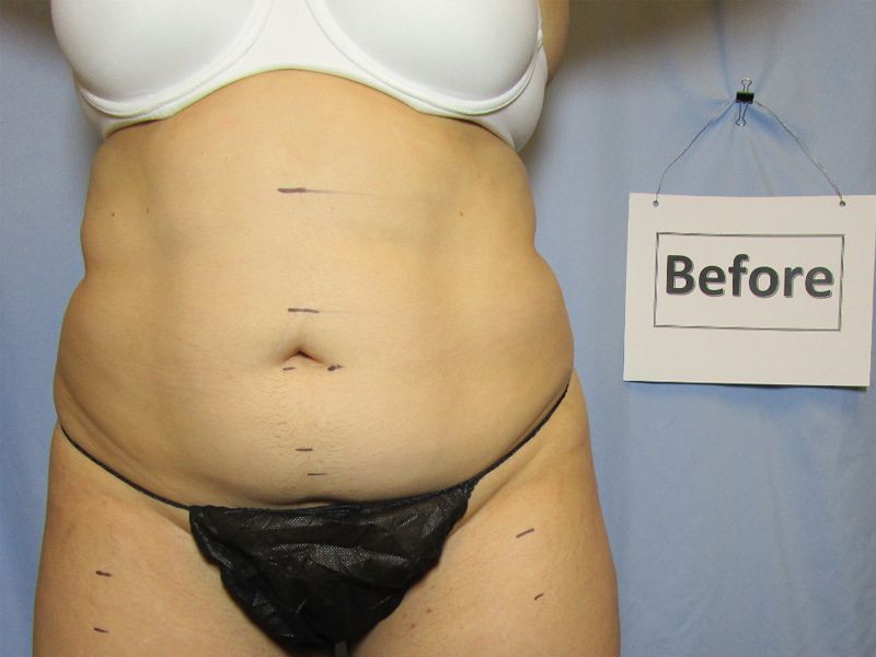before weight loss