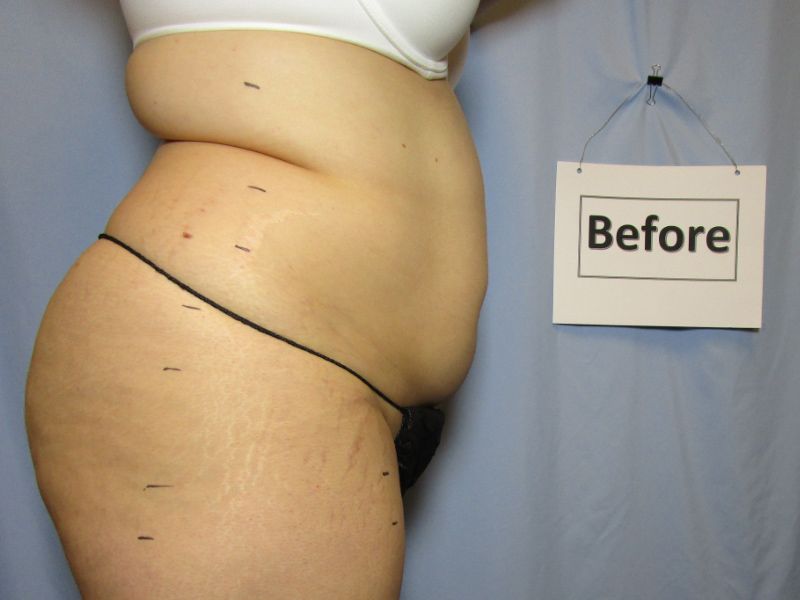 before weight loss