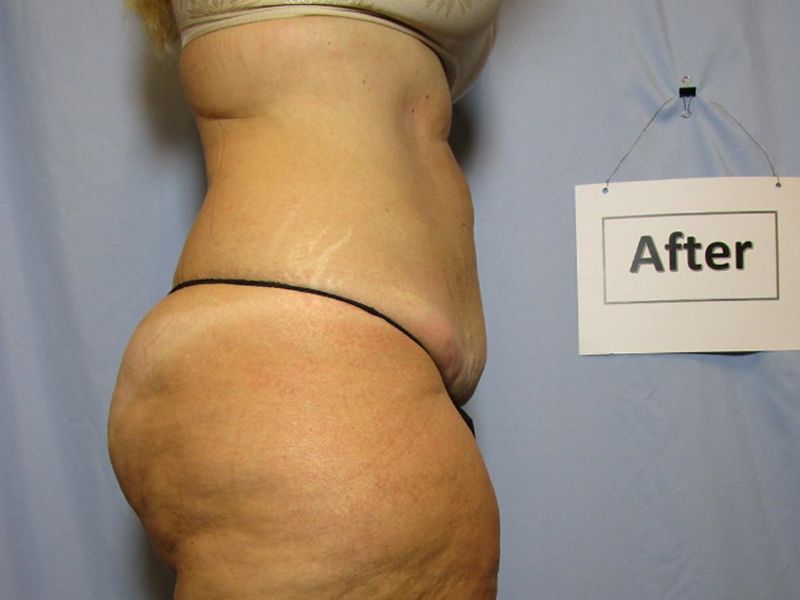 Laser Liposuction After
