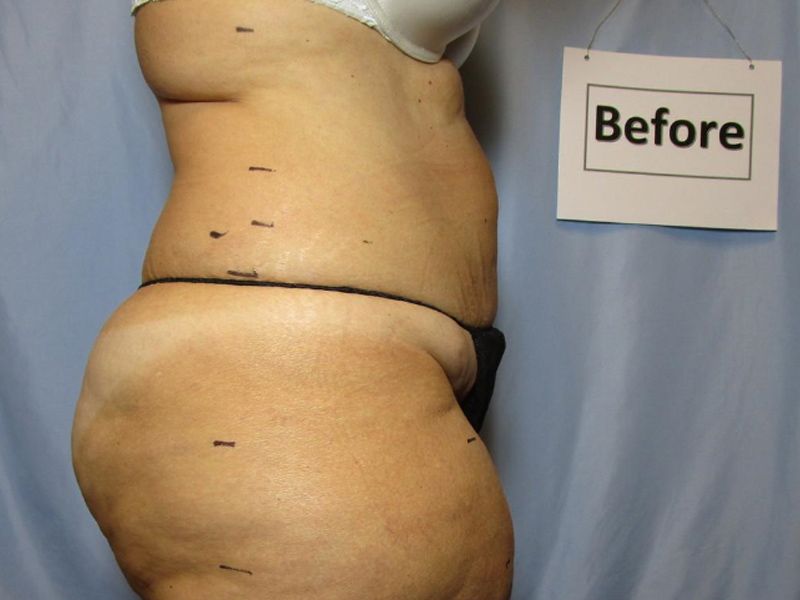 Laser Liposuction Before