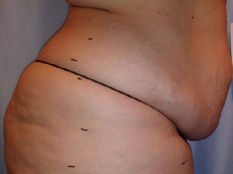 before laser lipo