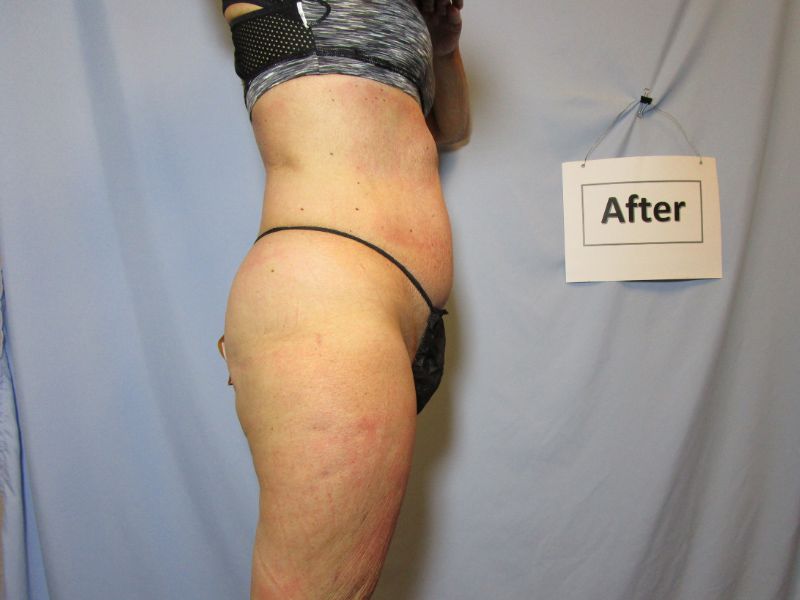 Laser Liposuction After