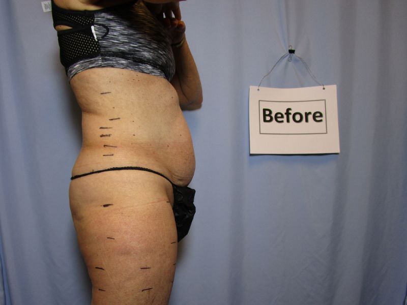 Laser Liposuction Before