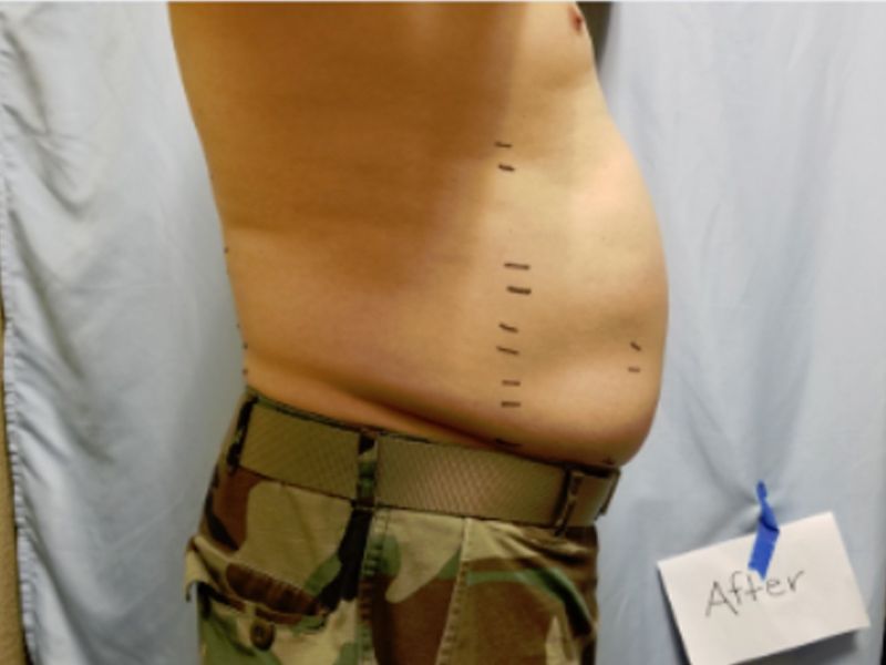 laser liposuction after