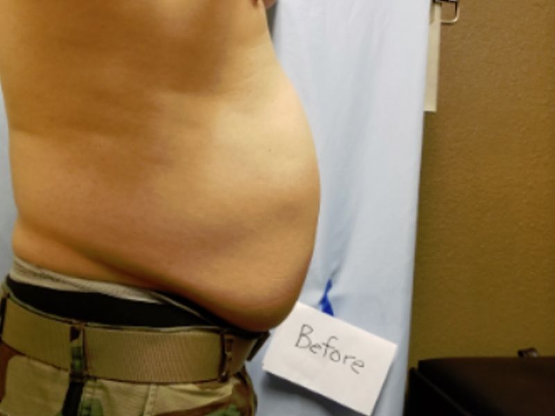 laser liposuction before