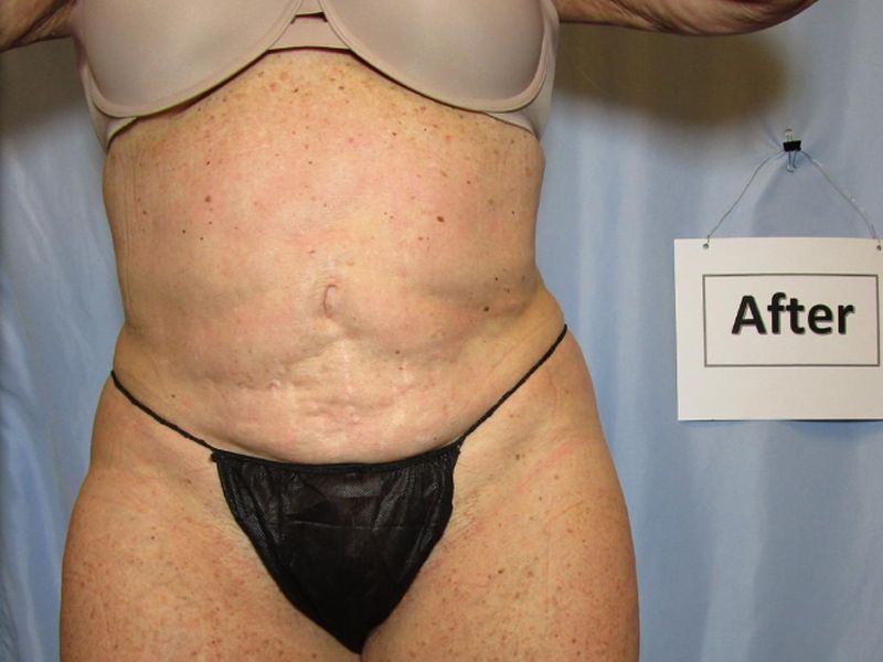 after weight loss
