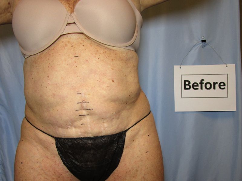 before weight loss