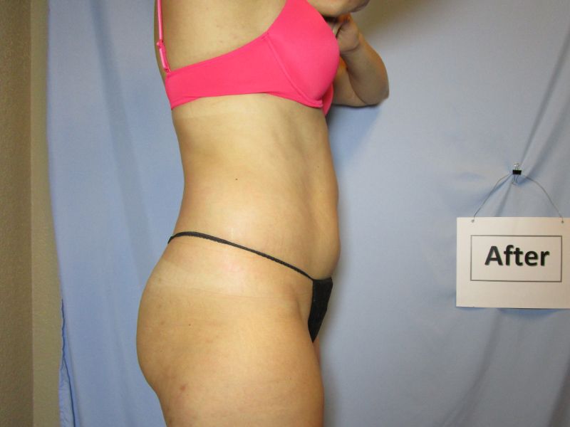 Fat Loss After