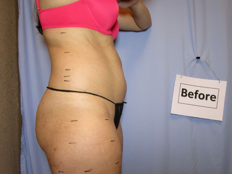 Fat Loss Before