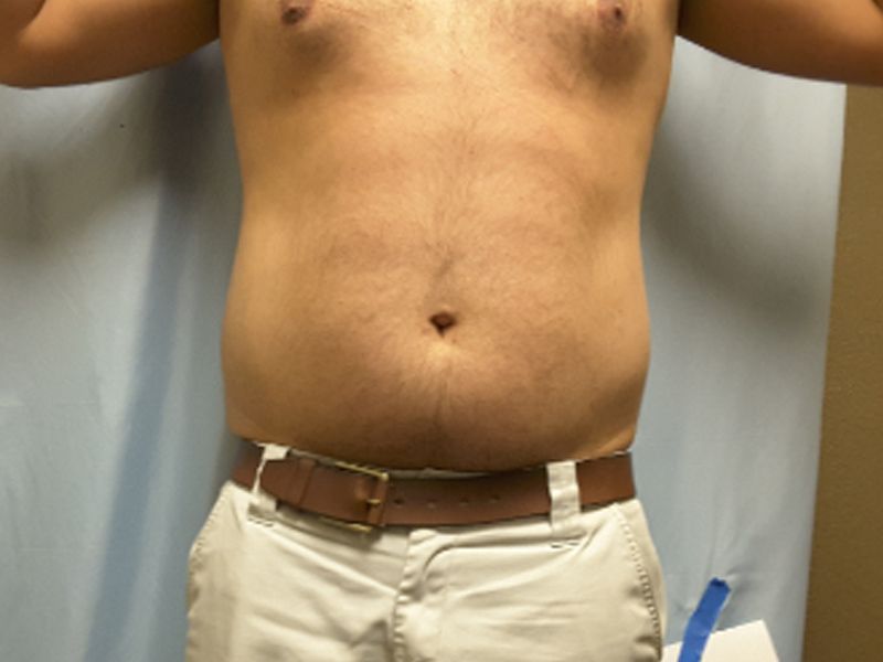 after weight loss