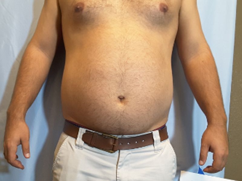 before weight loss