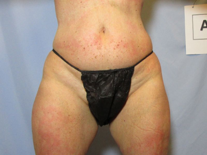after weight loss