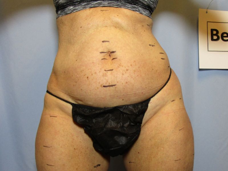before weight loss
