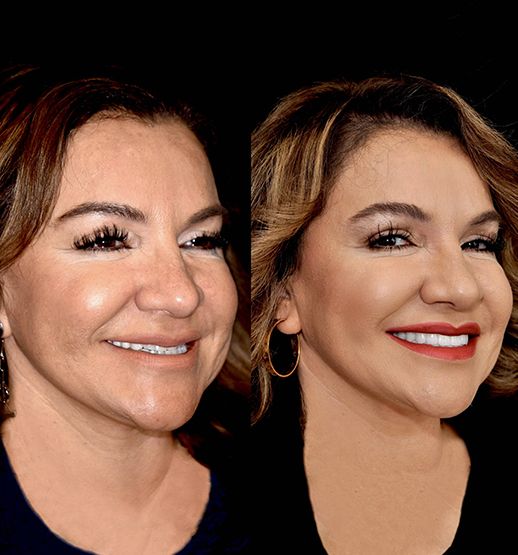 smile makeover before & after