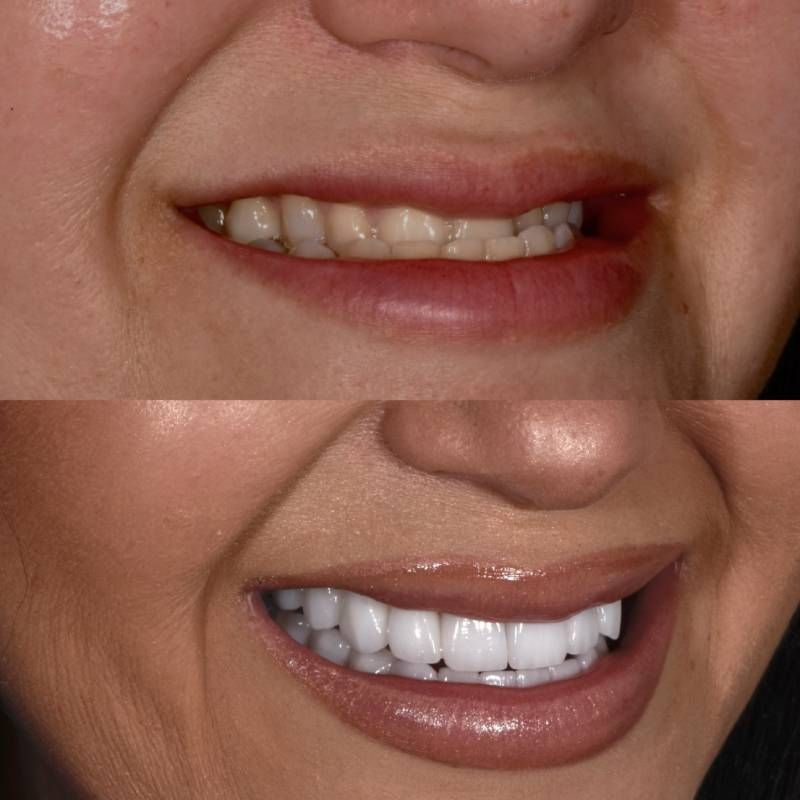 Veneers for Bite Correction Smiles by Dr. P Beverly Hills