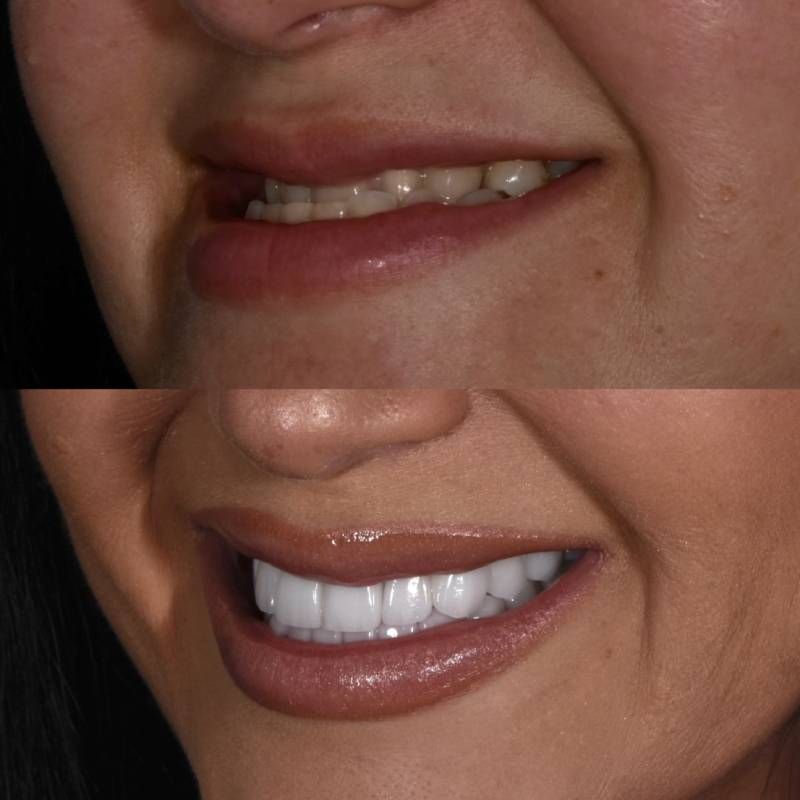 Veneers for Bite Correction Smiles by Dr. P Beverly Hills