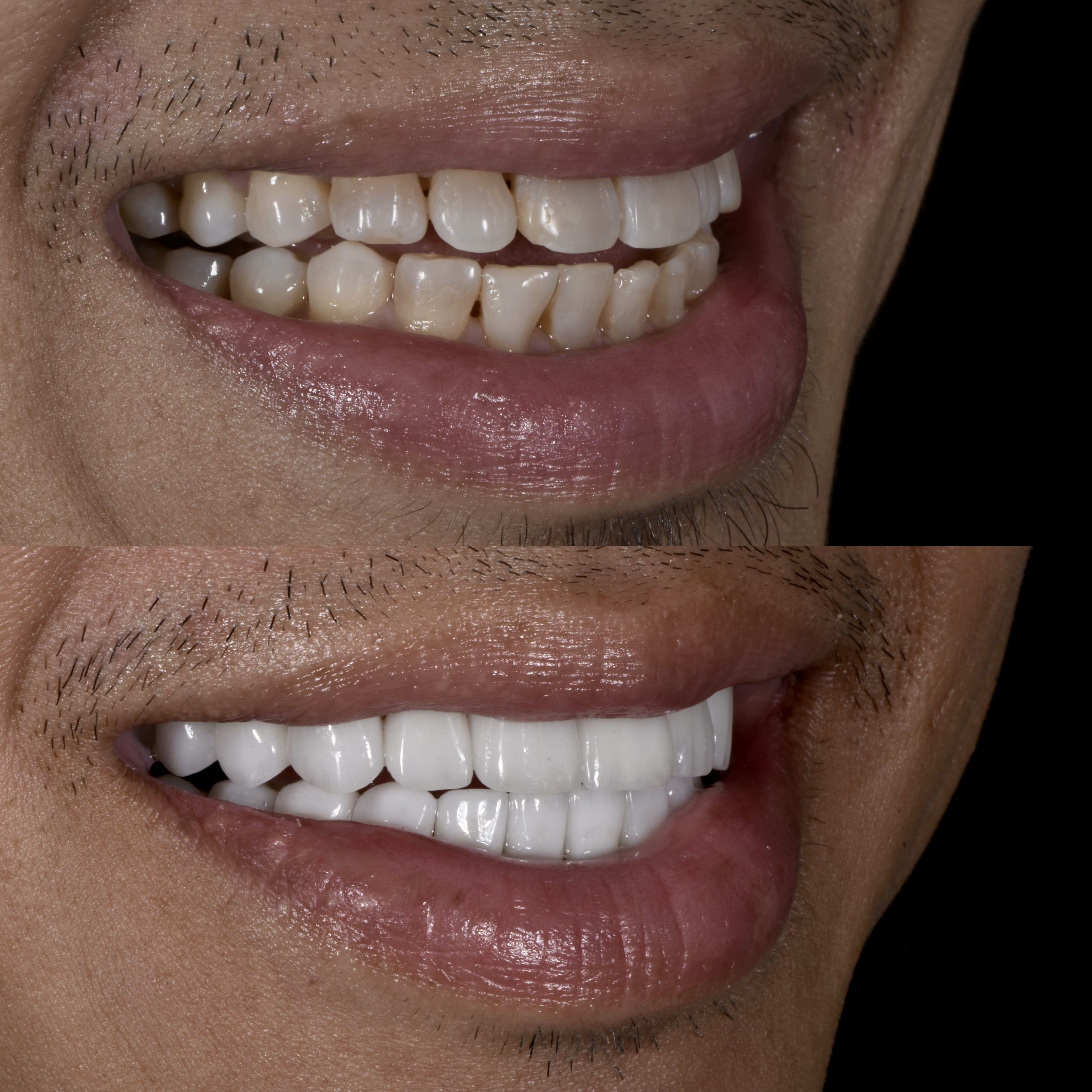 Veneers for Tetracycline Stain Veneers by Smiles by Dr. P