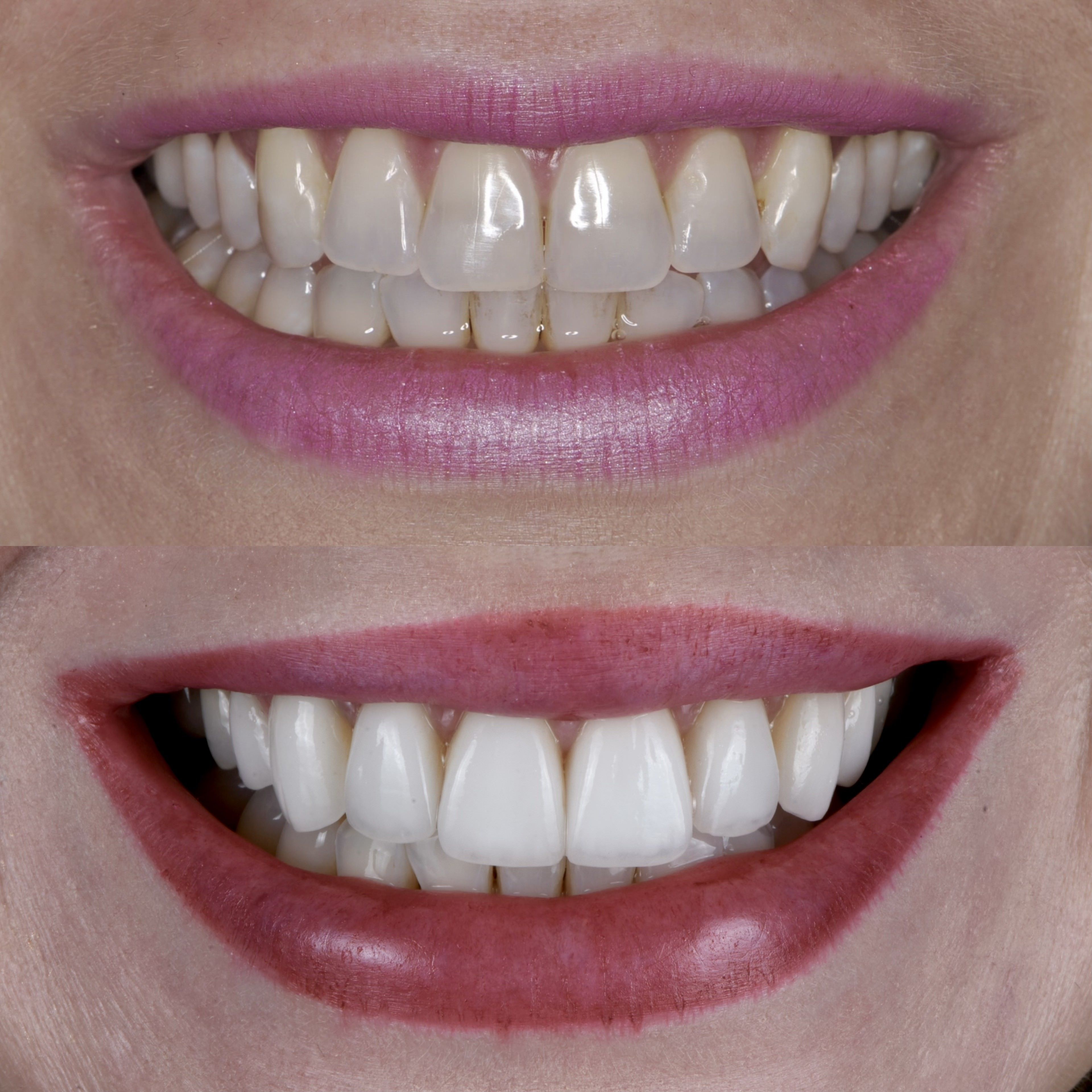 Veneers for Tetracycline Stain Veneers by Smiles by Dr. P