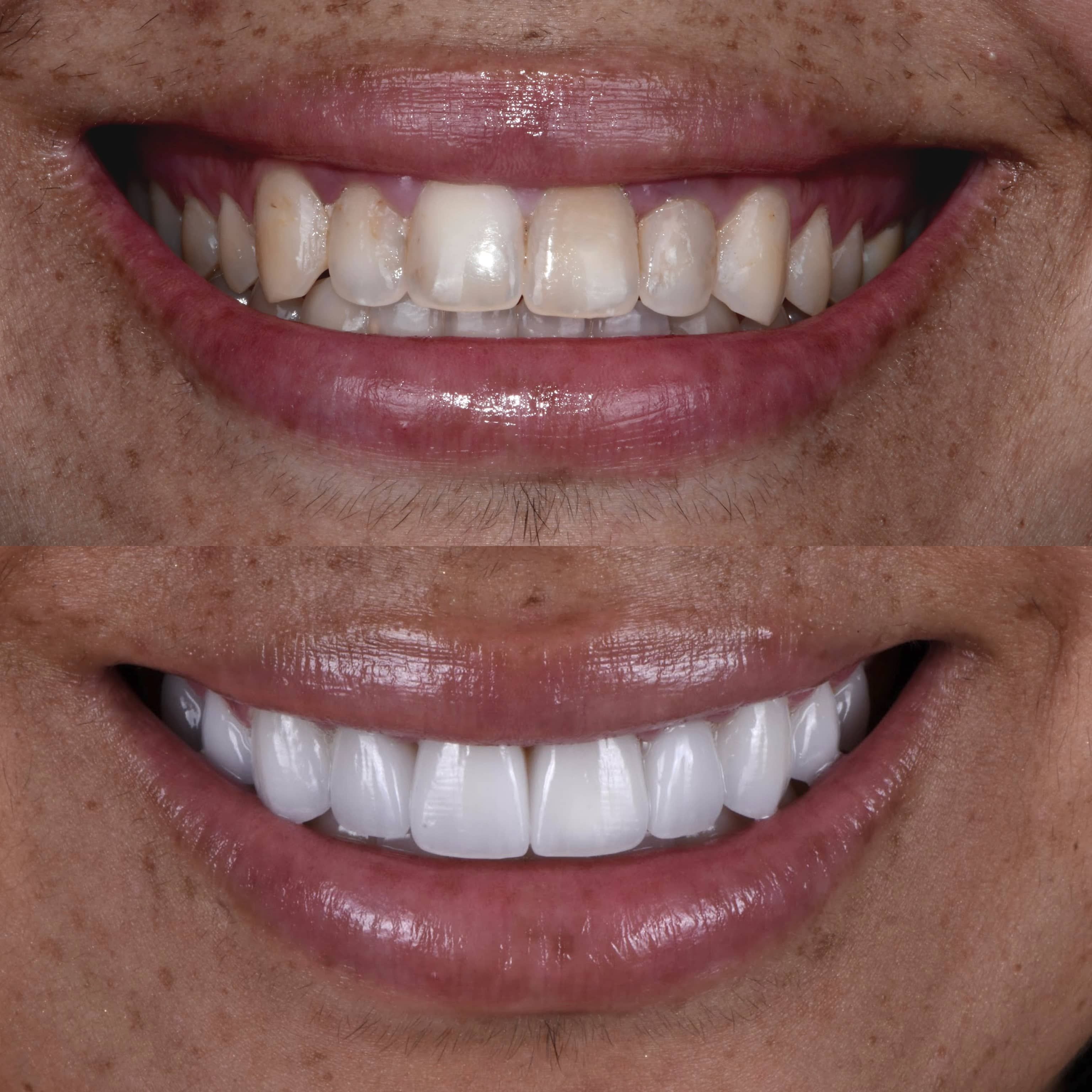 Patient results of veneers in Los Angeles