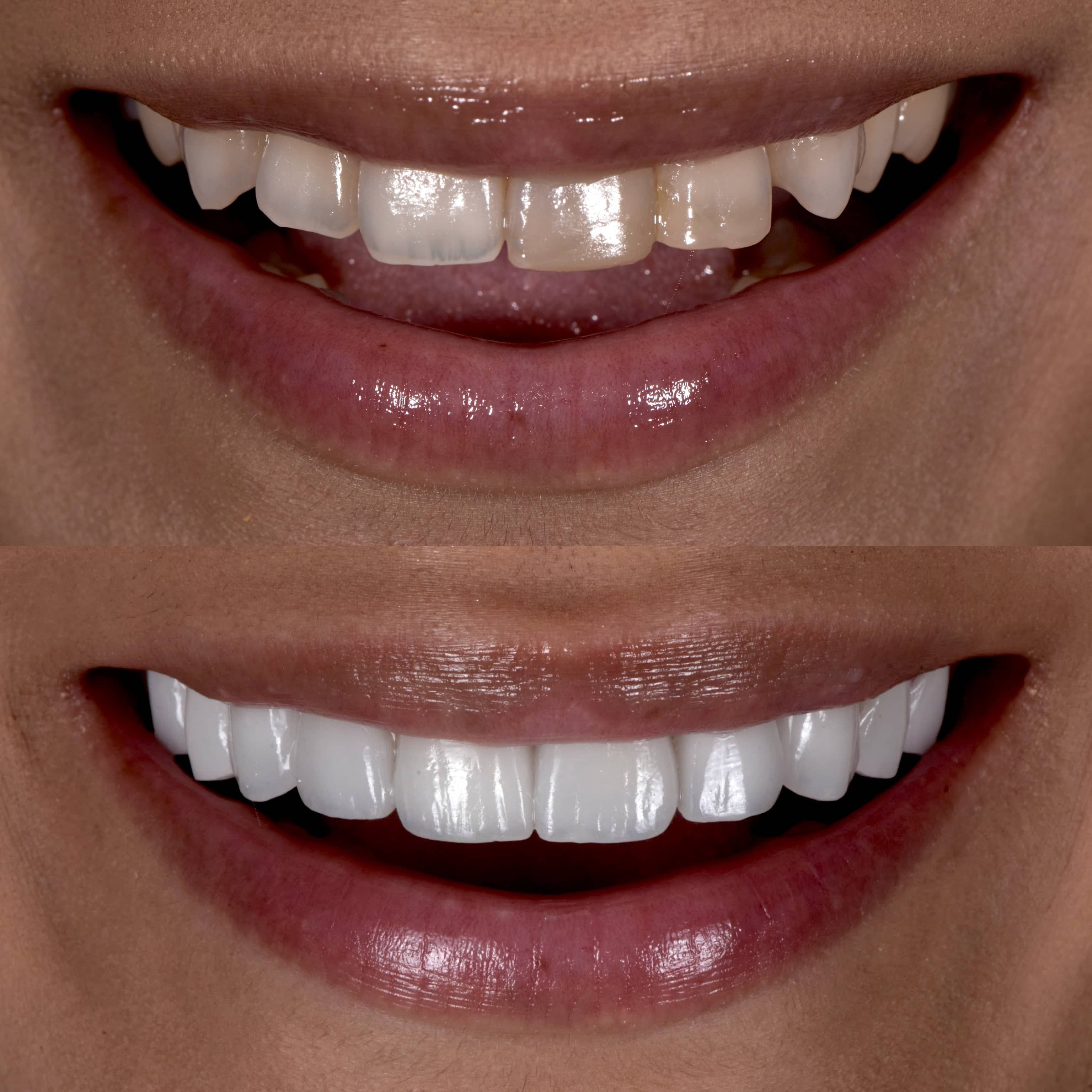 Comprehensive veneers service by Beverly Hills cosmetic dentist