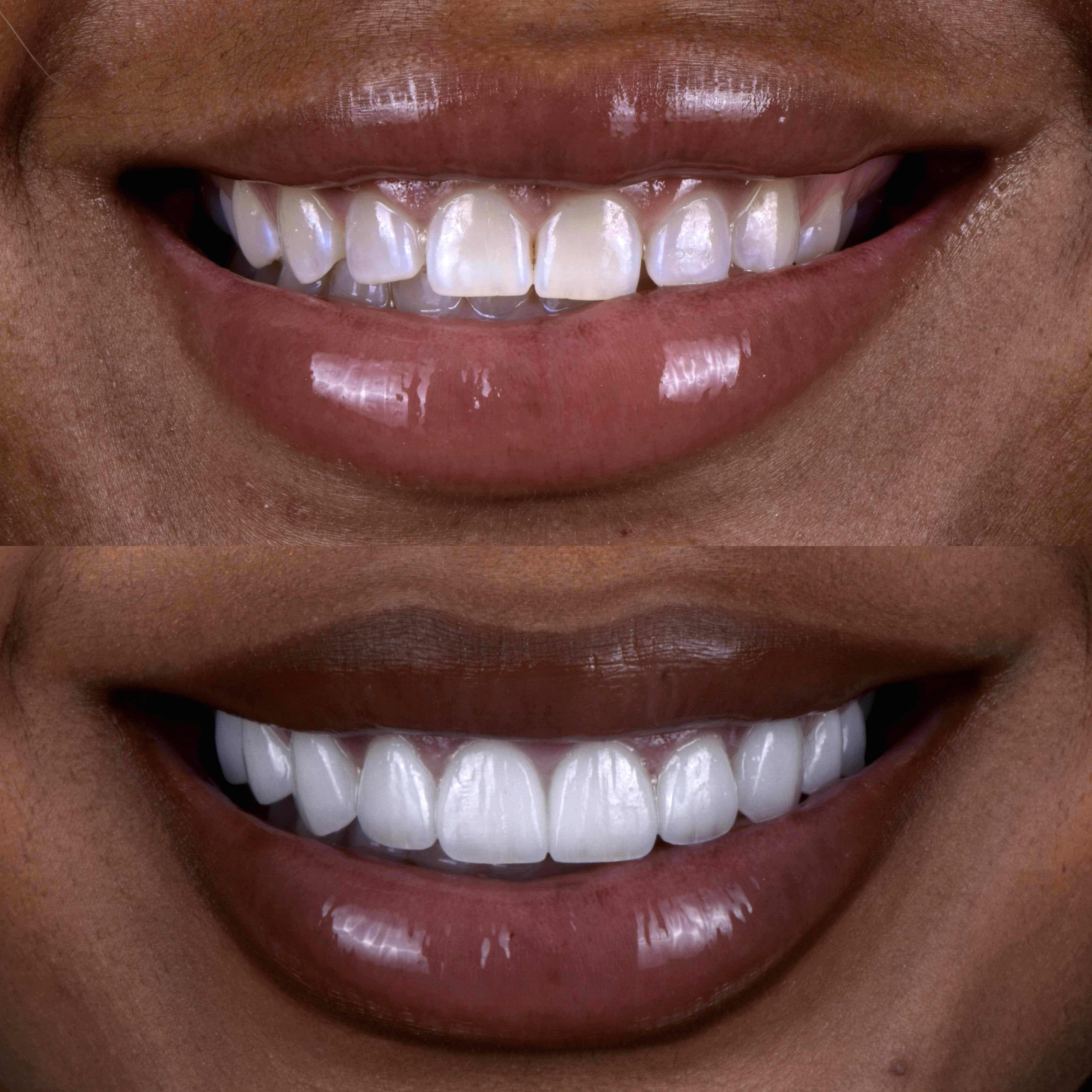 Gallery of veneers results from Beverly Hills dental practice