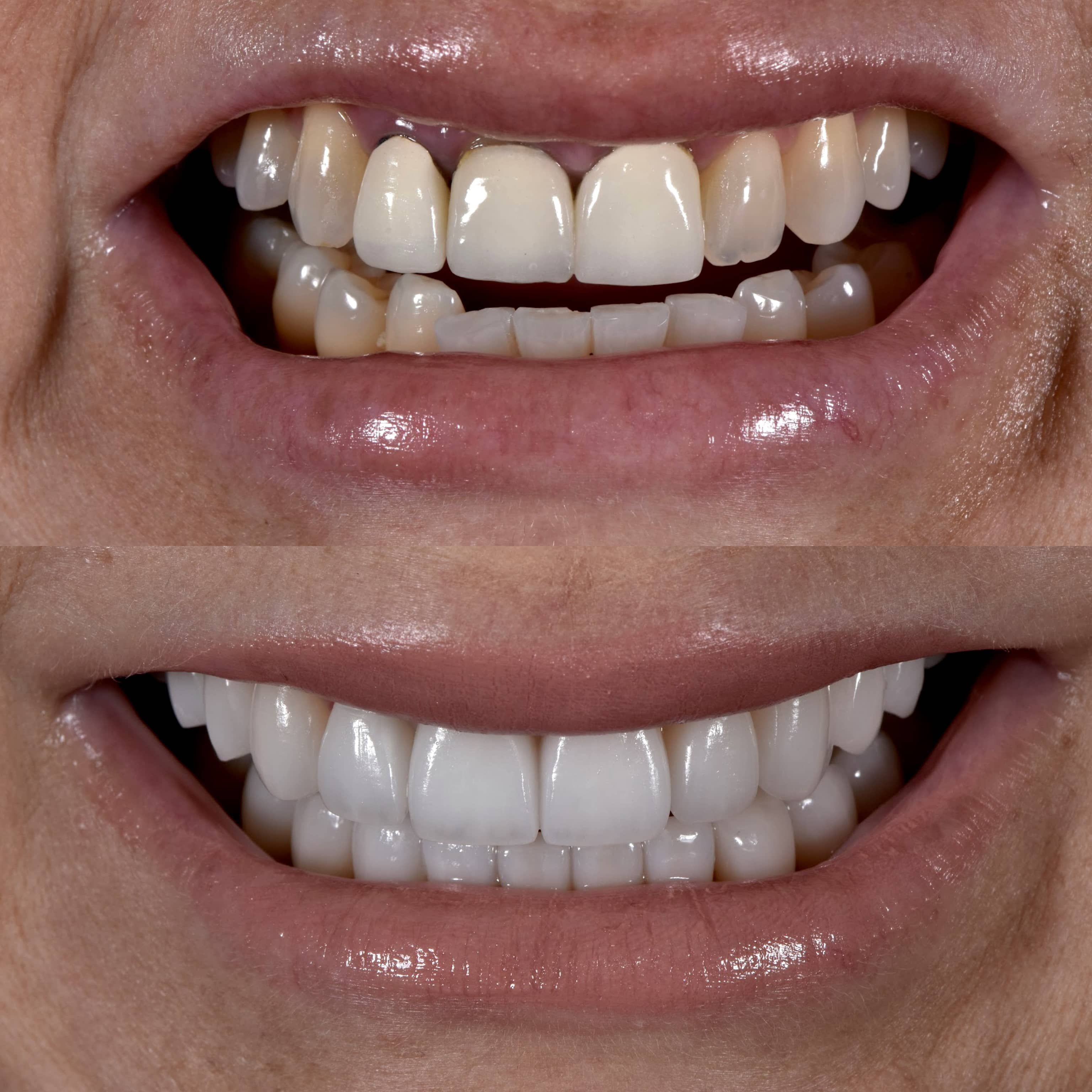 Los Angeles dentist showing veneer results