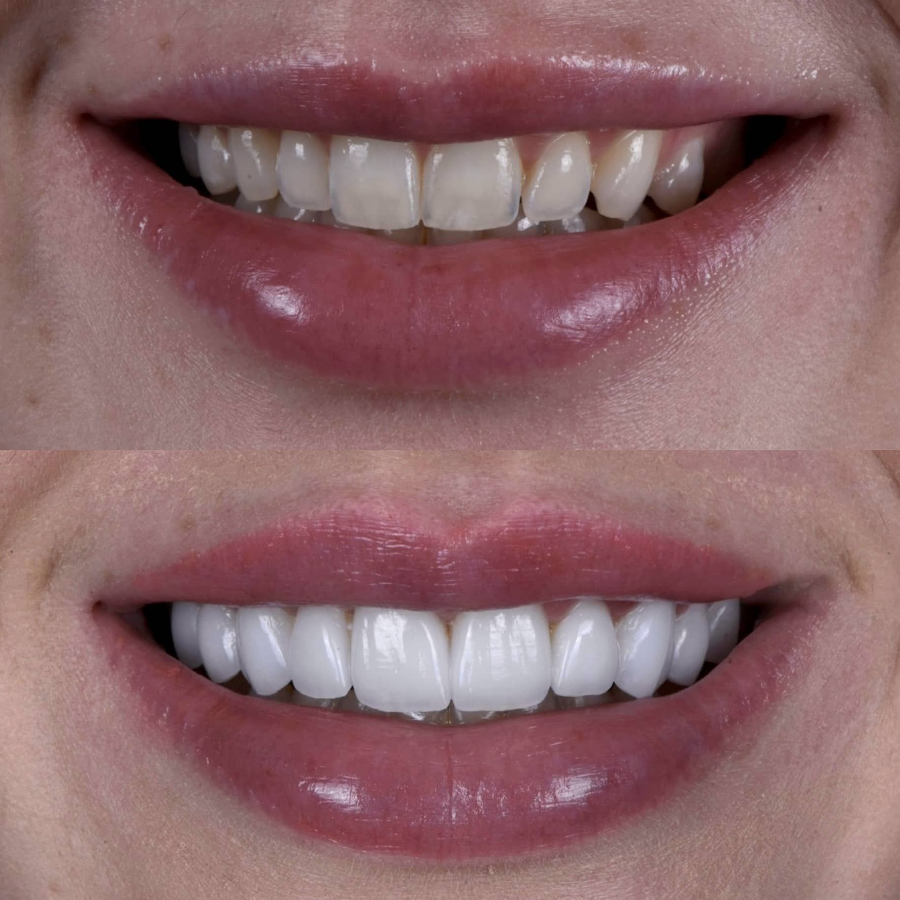 LA dentist showing veneer results