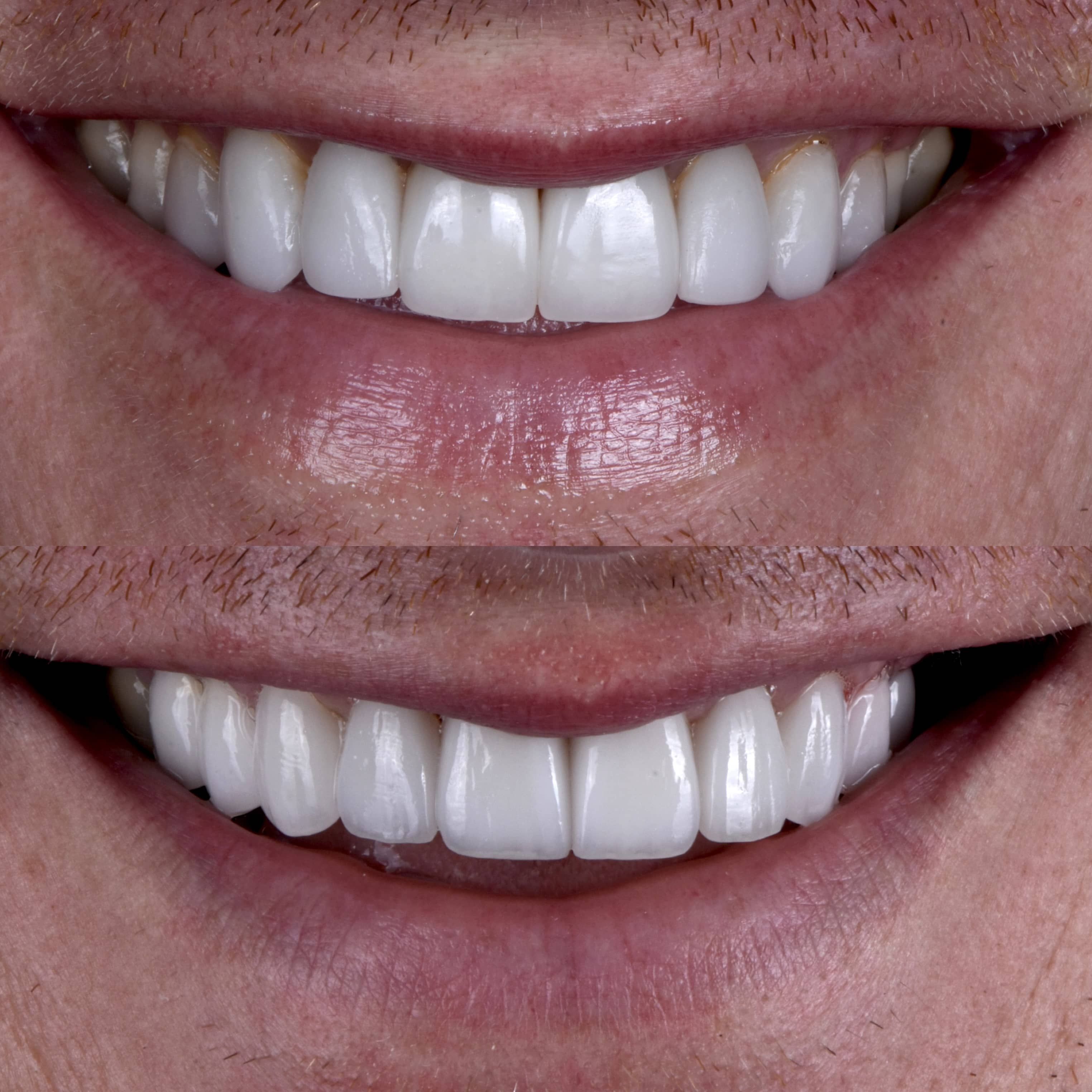 Beverly Hills dentist showing veneer results