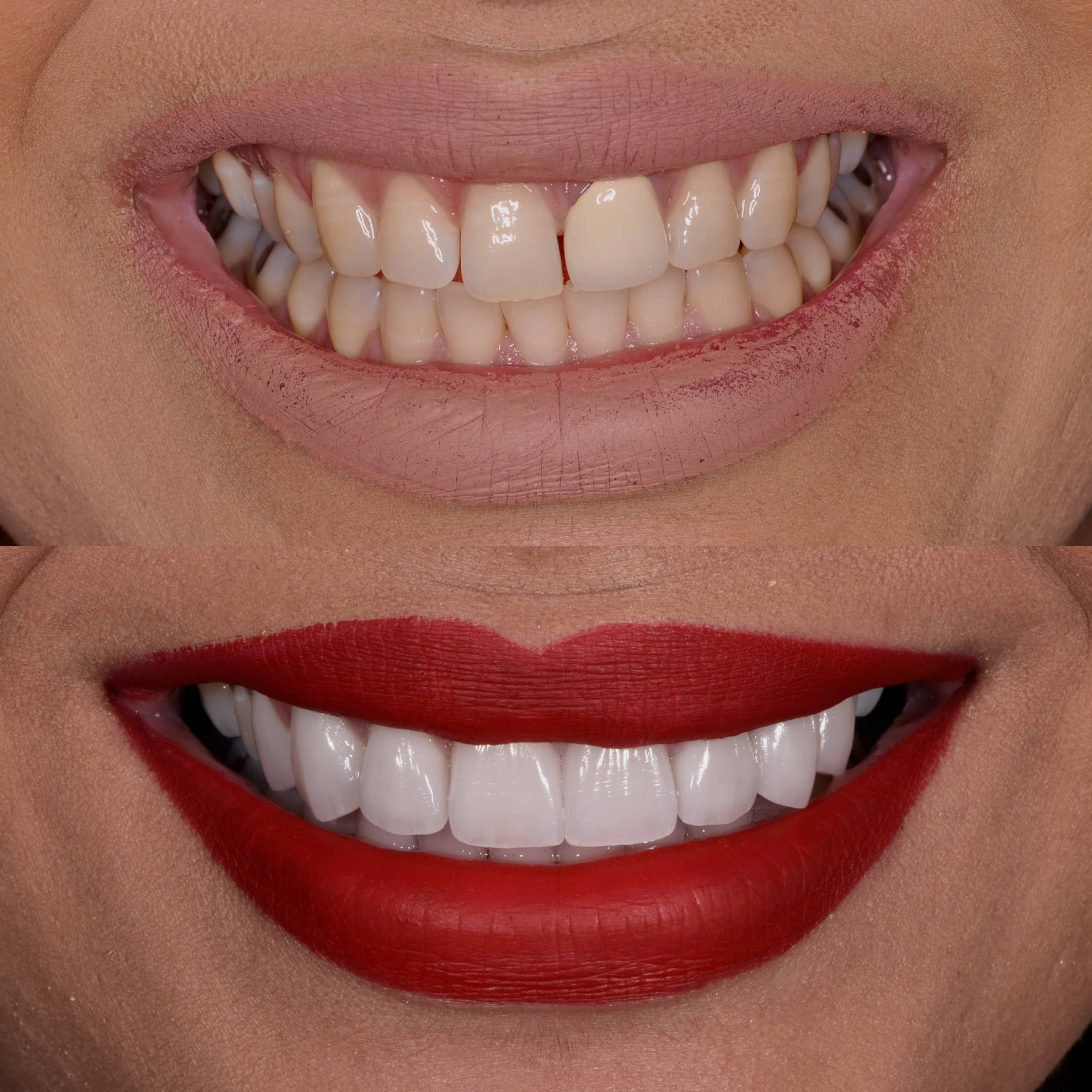 Teeth Whitening Before and after