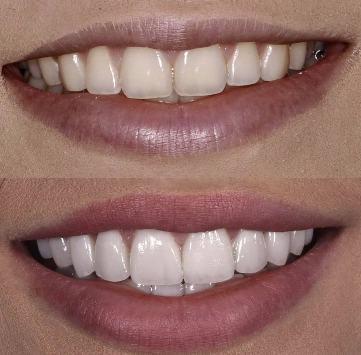 before & after gallery for Veneers in Los Angeles, CA