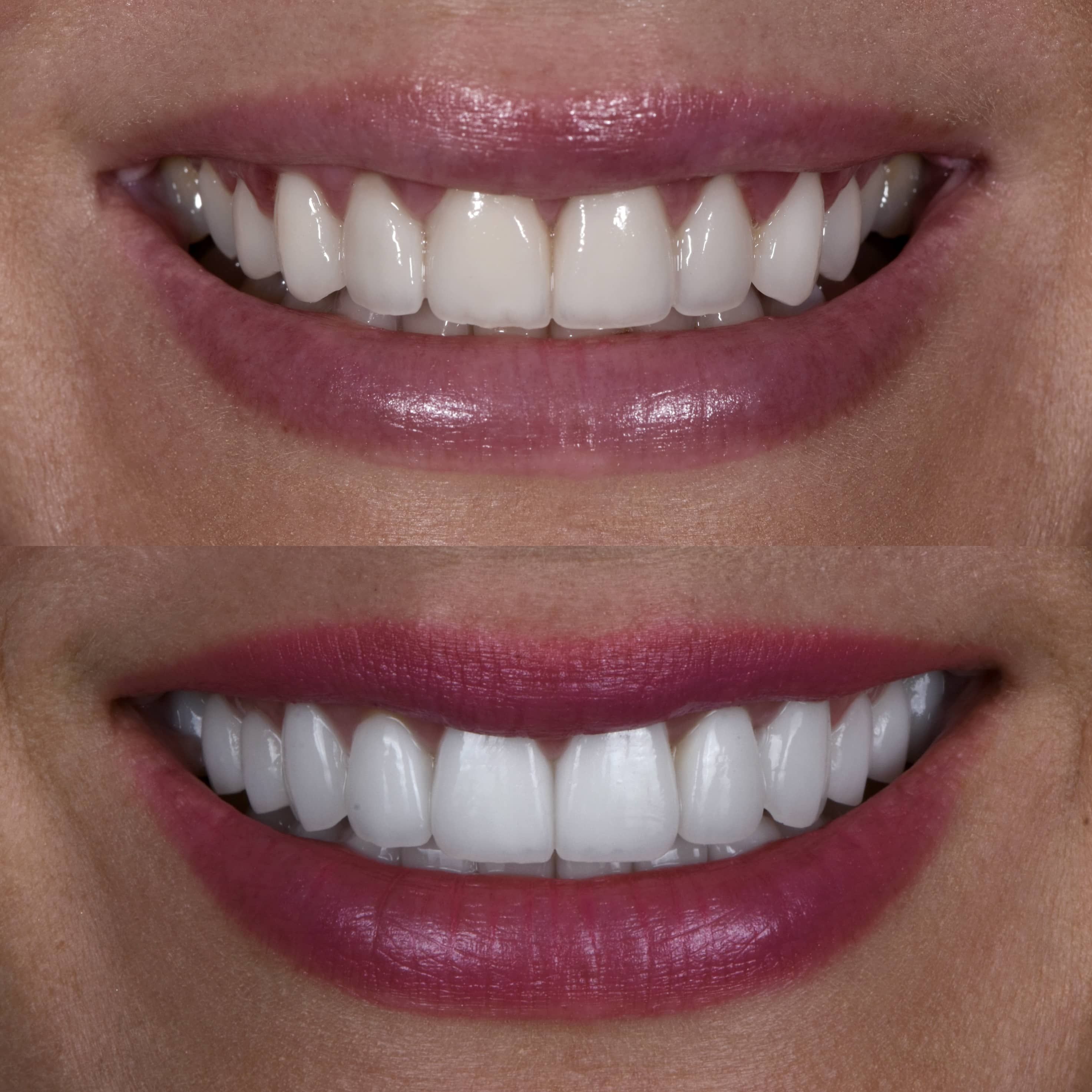 Custom dental veneers fitting in Los Angeles dental office