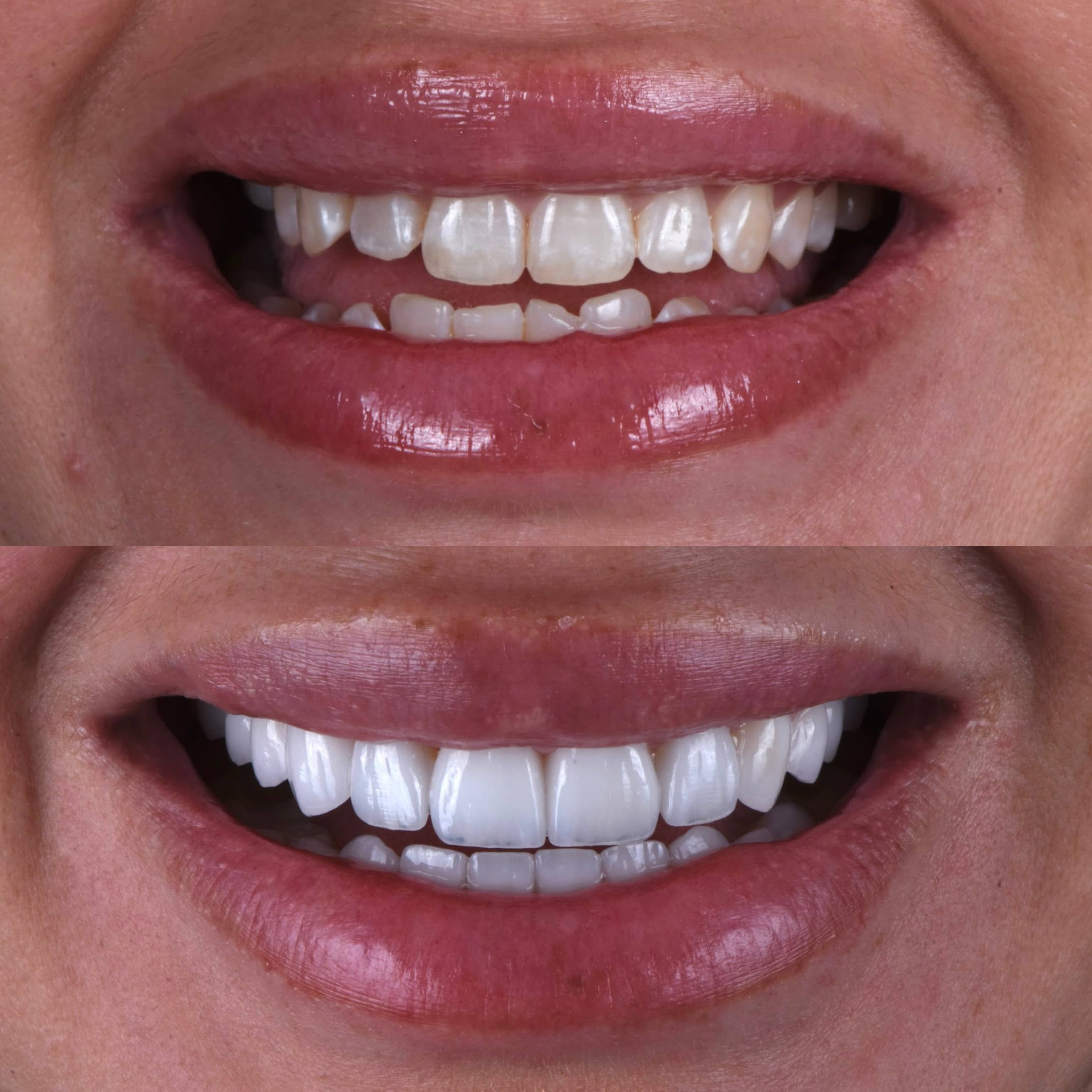 veneers in LA - before and after