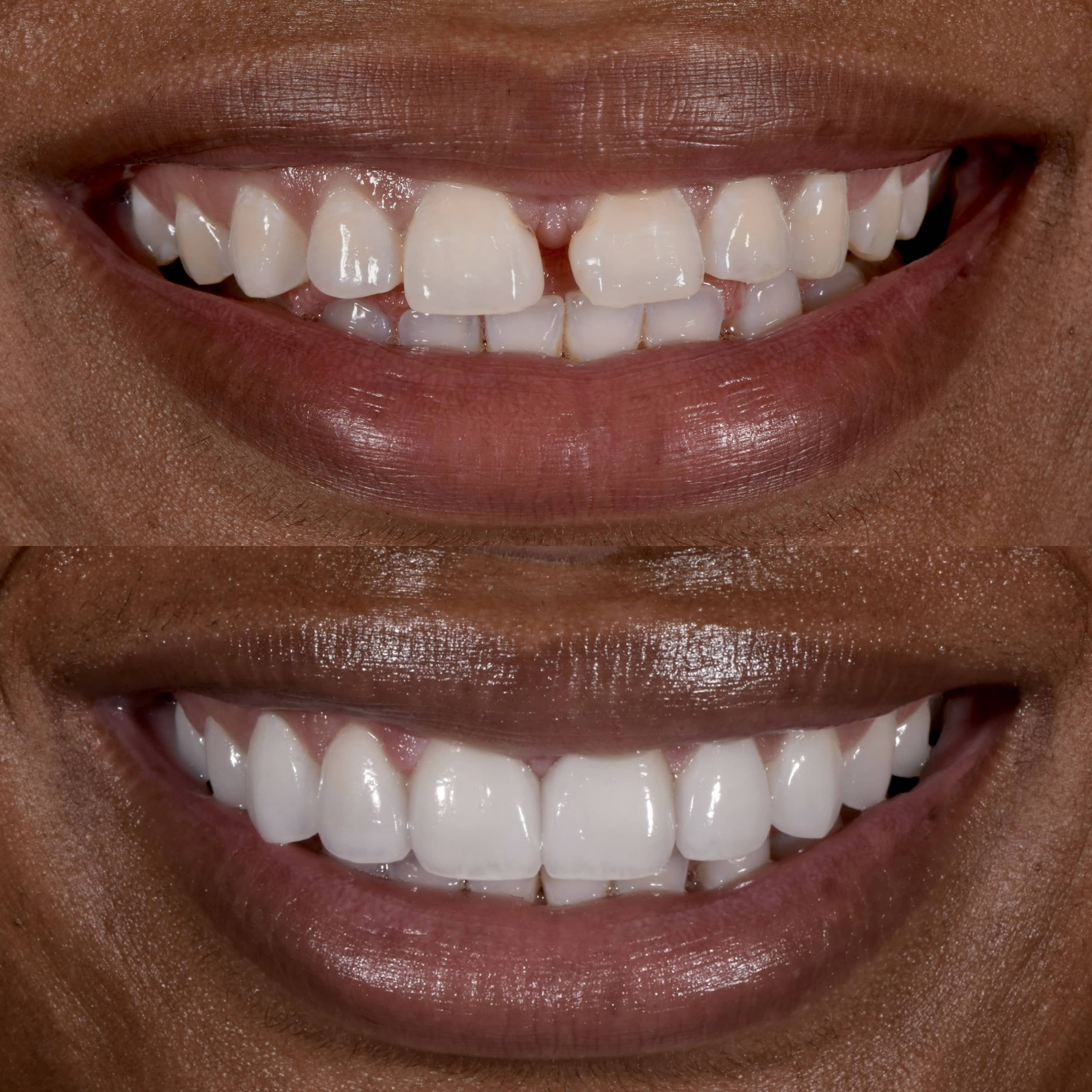 Smiling patient with veneers at Los Angeles cosmetic dentistry