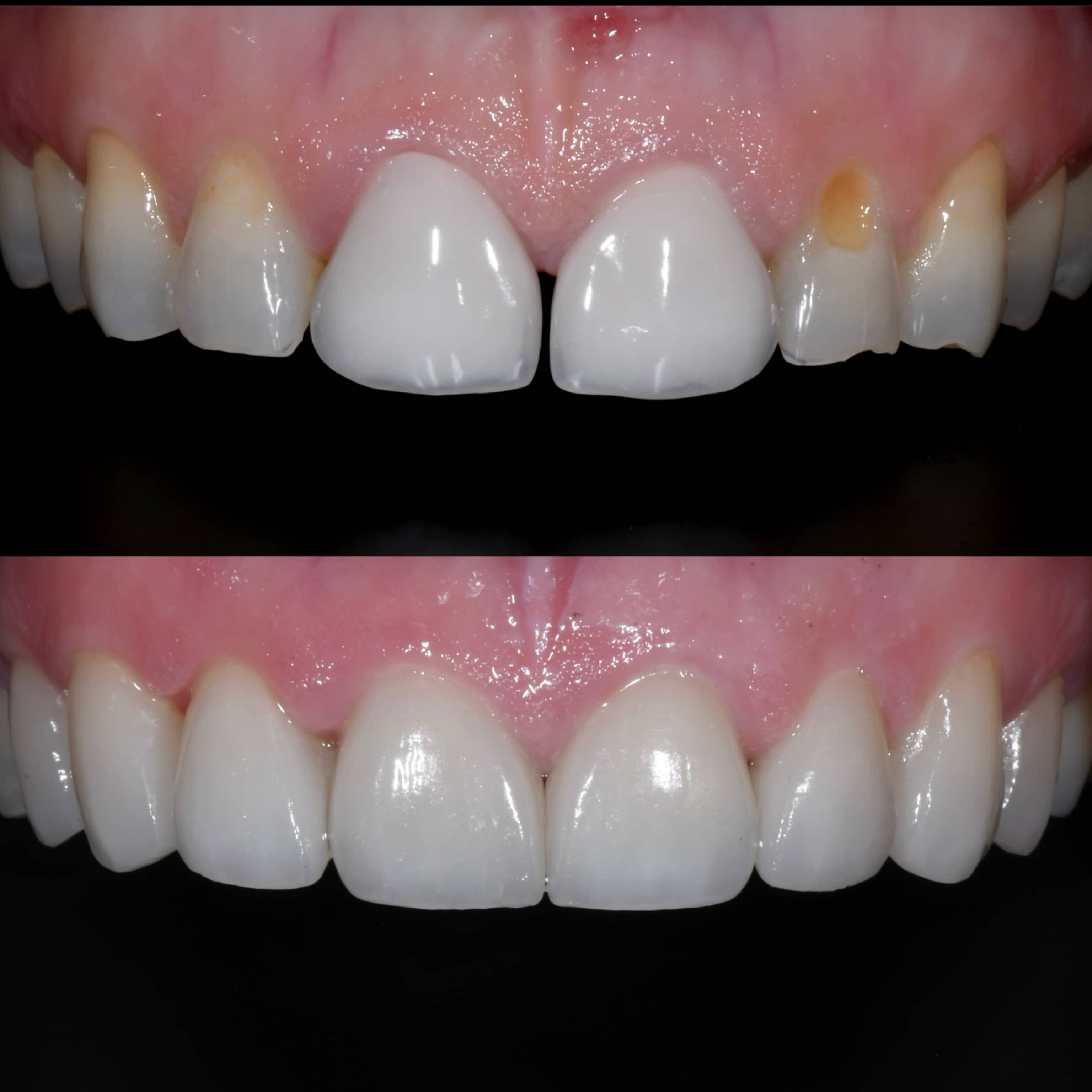 up close teeth veneers before and after | Los Angeles