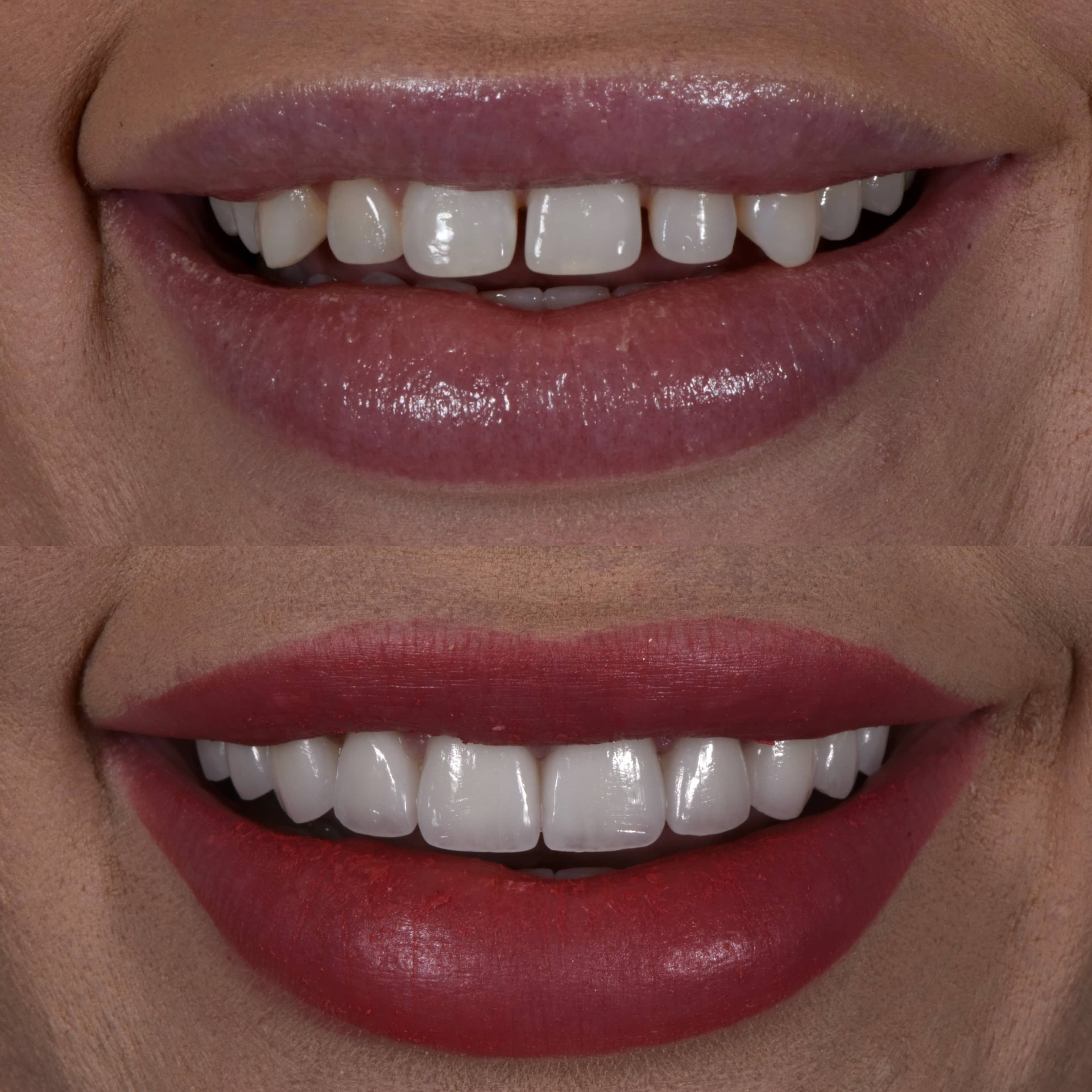 veneers in Beverly Hills - before and after