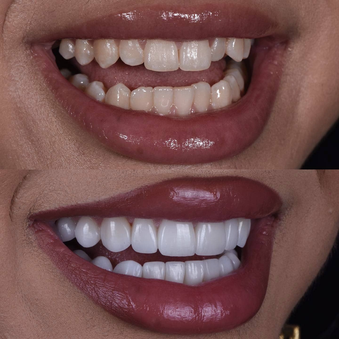 Veneers for Crowded Teeth/ Misalignment Smiles by Dr. P Veneers