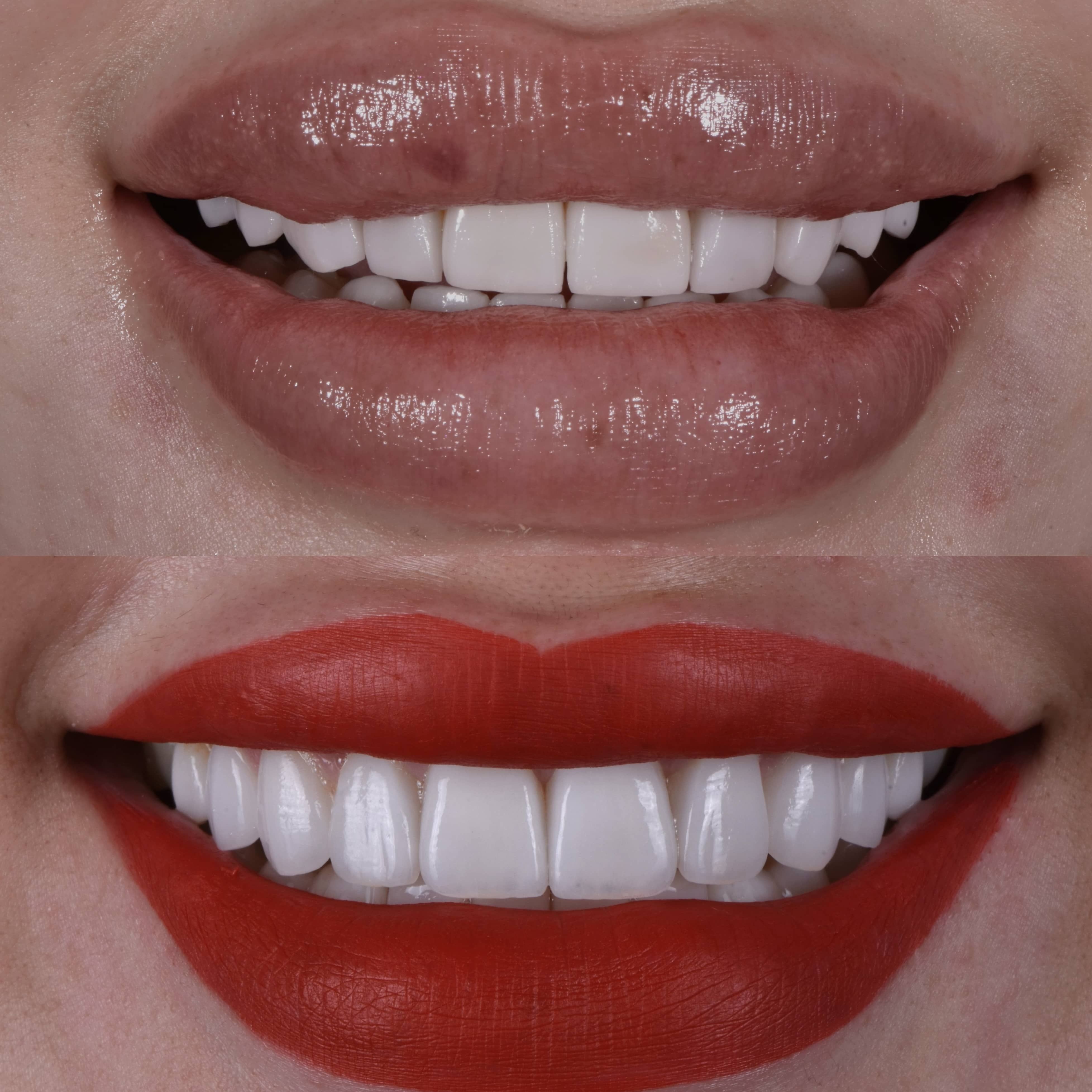 porcelain veneers in LA - before and after