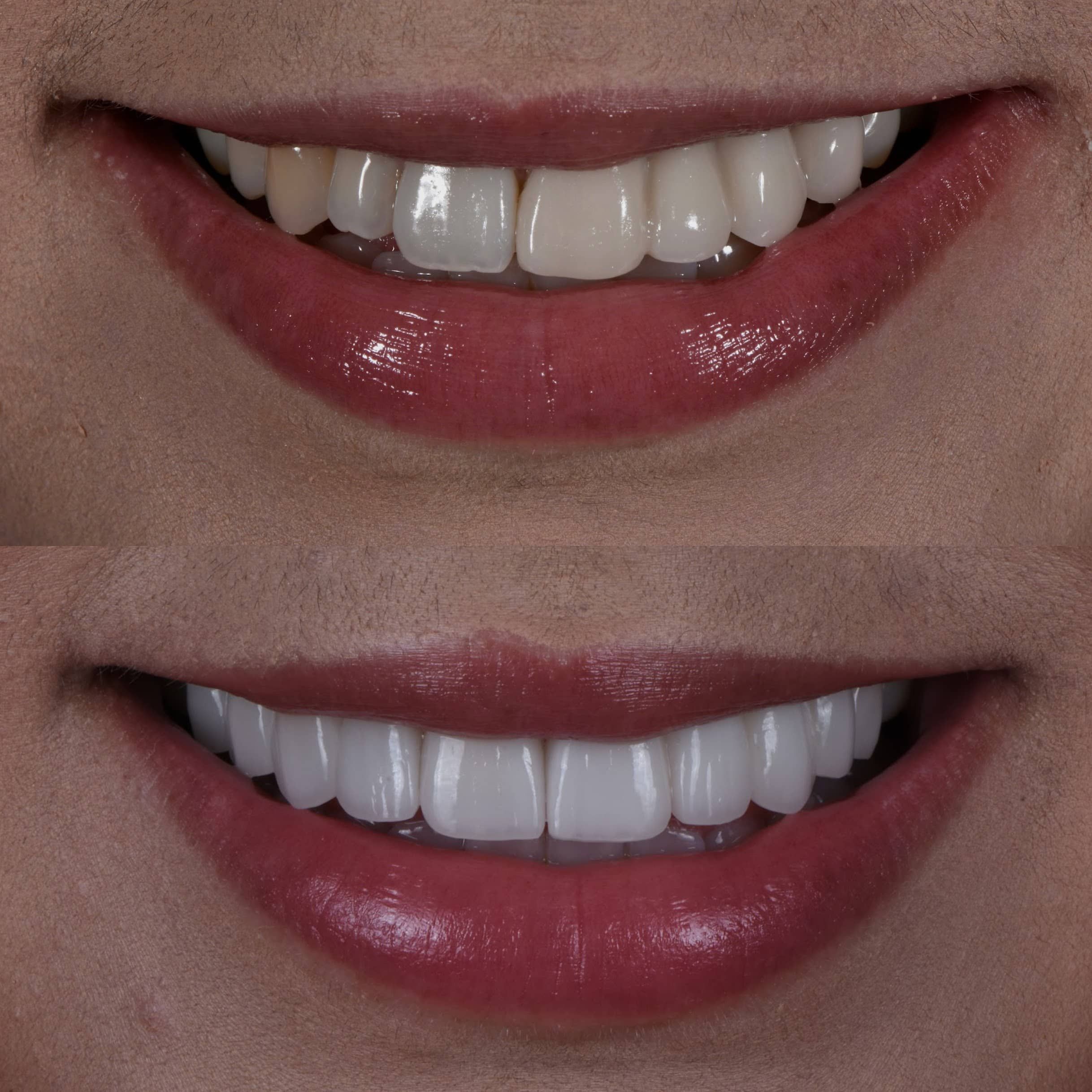 porcelain veneers in los angeles - before and after