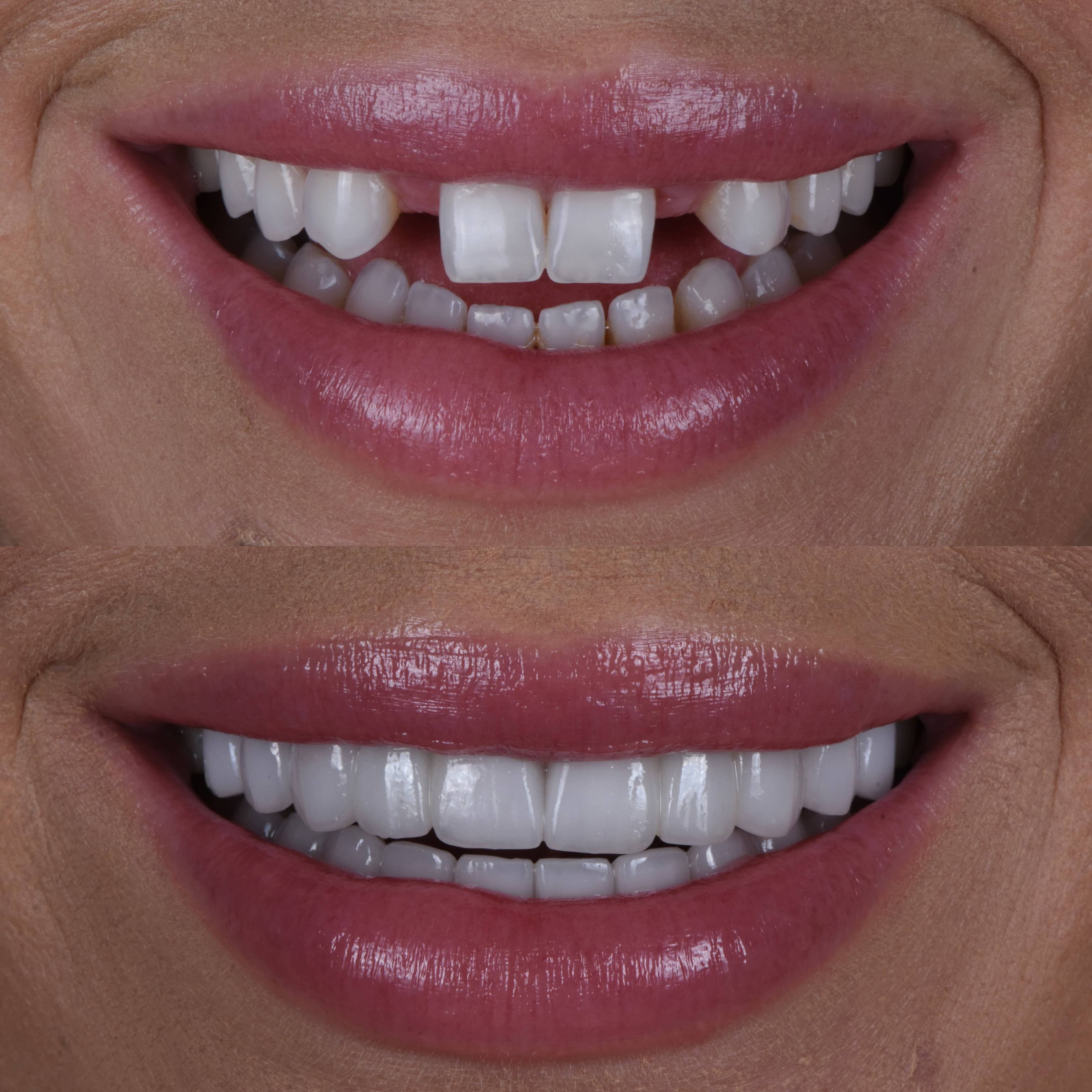 porcelain veneers in Beverly Hills - before and after