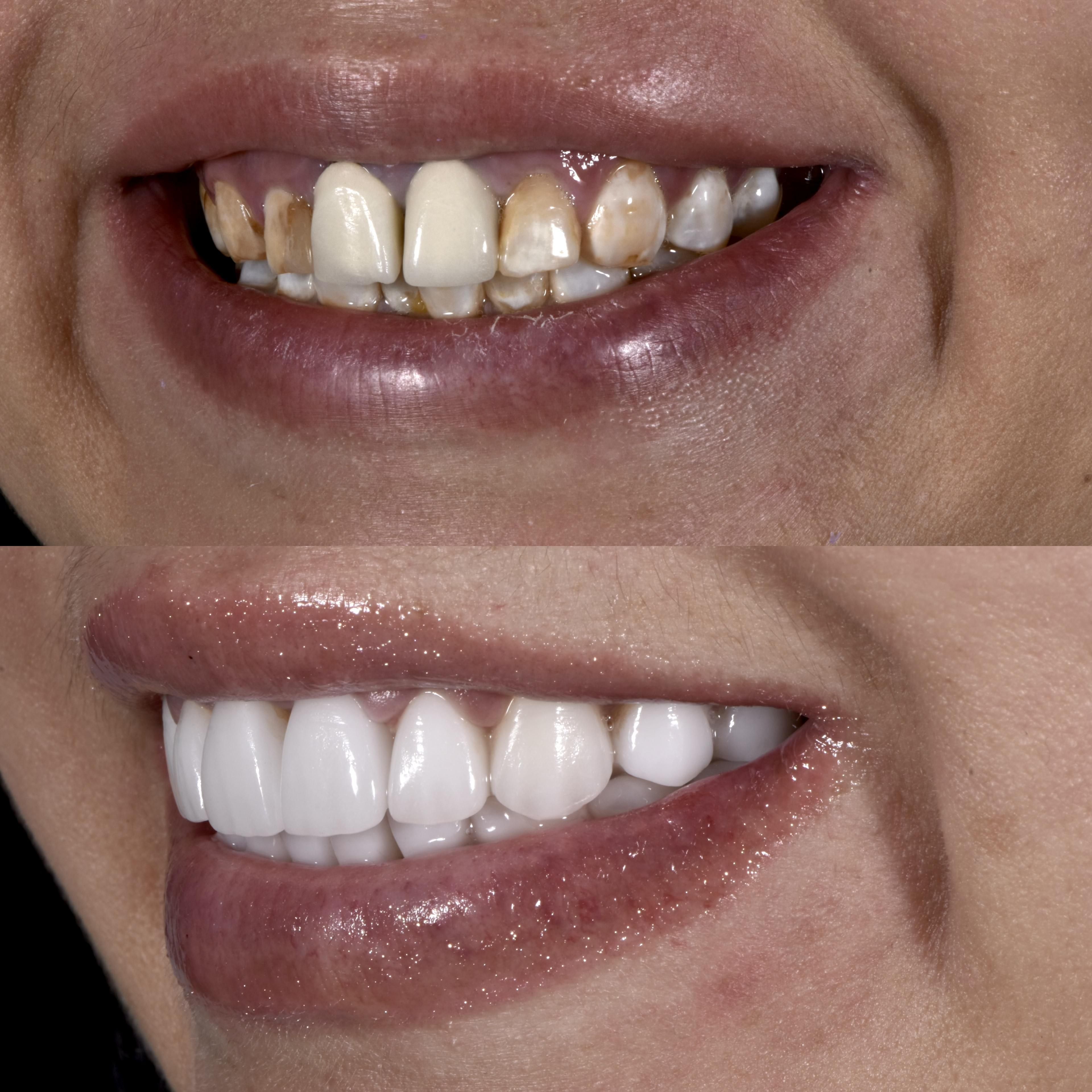 Veneers for Dental Fluorosis Smiles by Dr. P Beverly Hills