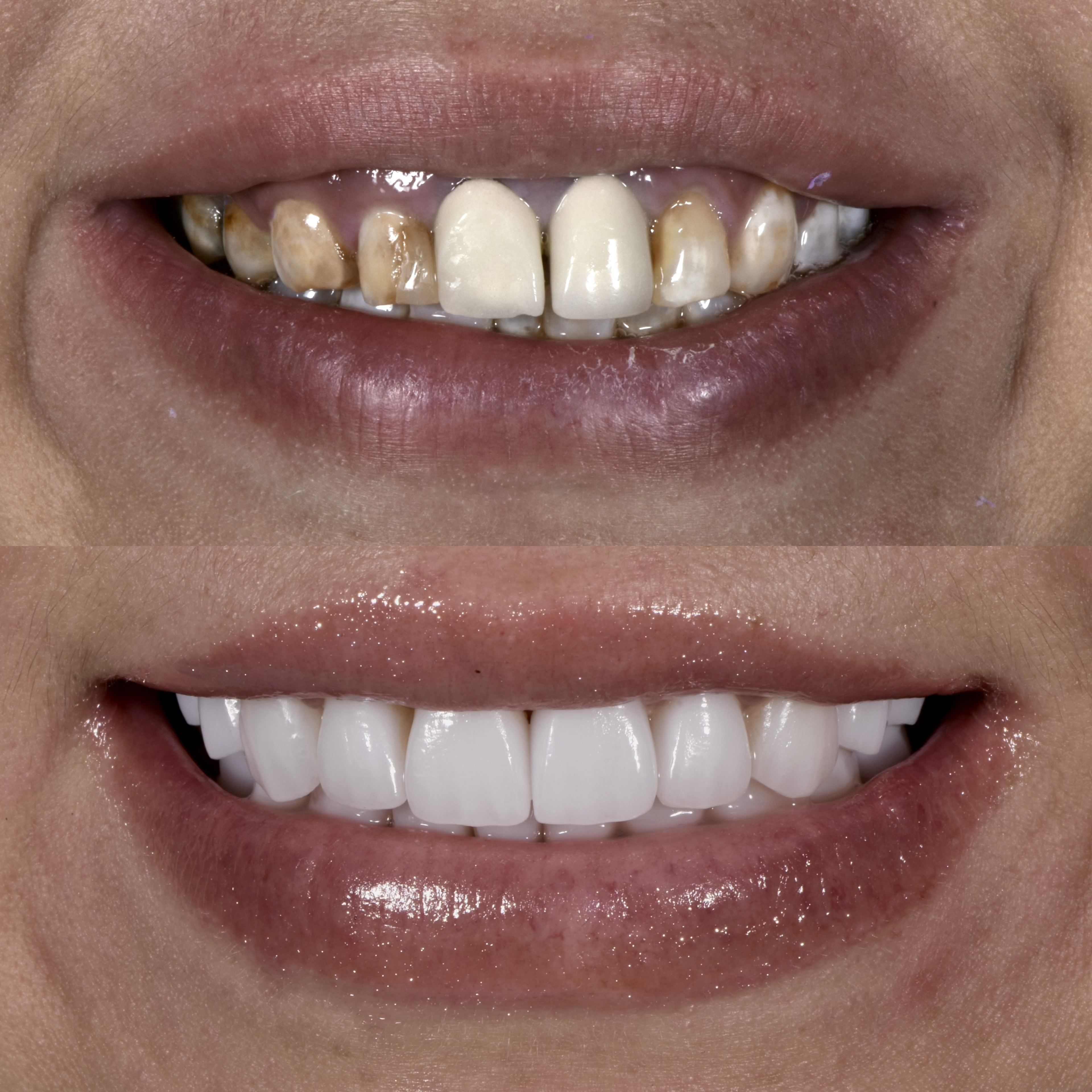 Understanding Stannous Fluoride Stains: A Visual Guide With Photos - sjspcuf