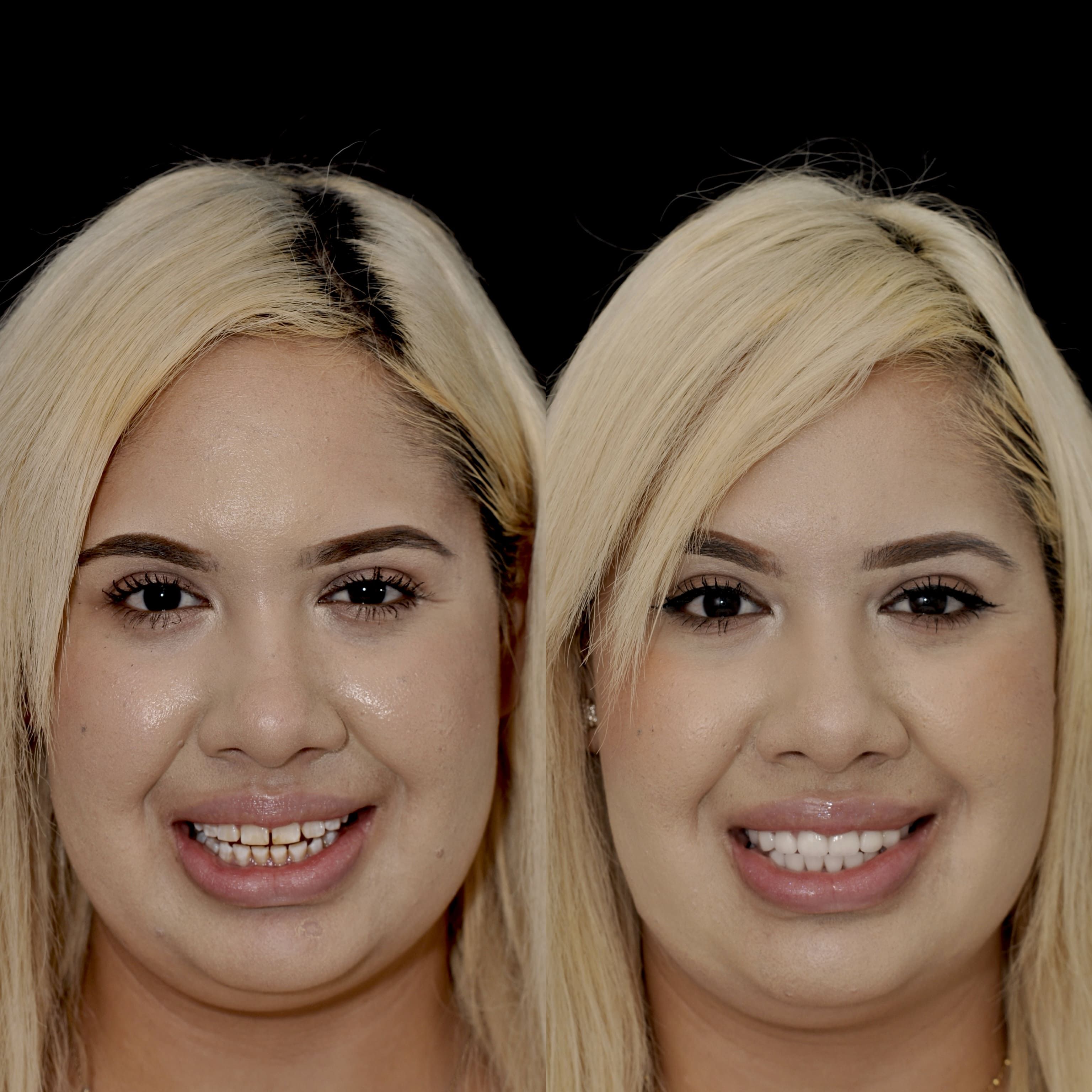 The Ultimate Guide To Stannous Fluoride Stains (With Real Patient Photos) - gz03qvs