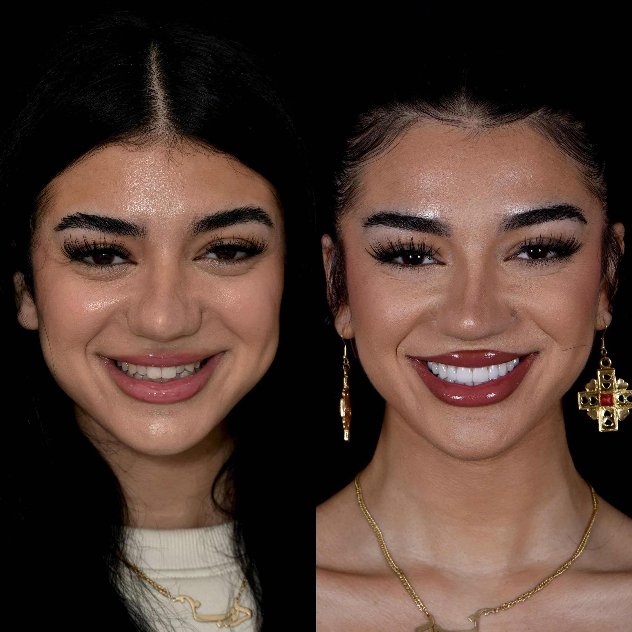 Gallery: Before and After Dental Veneers in Los Angeles, CA