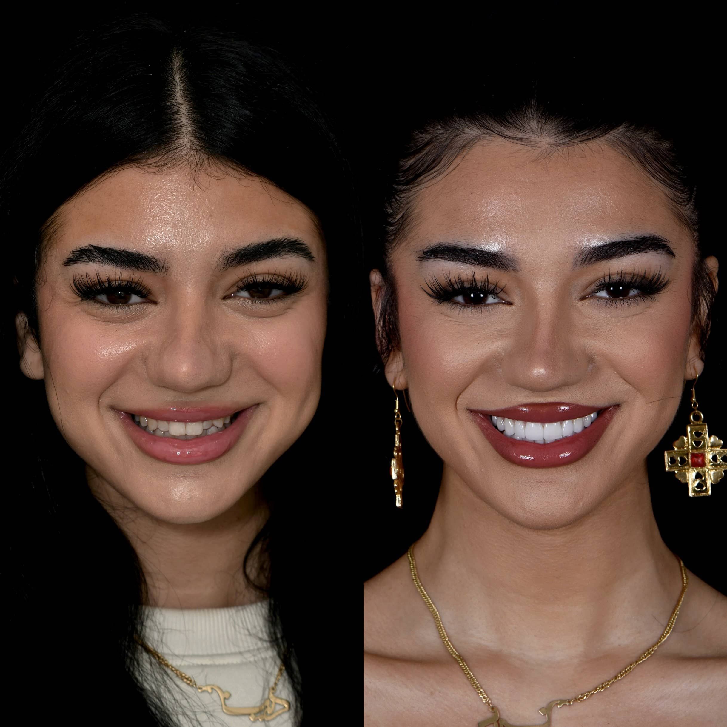 No Prep Veneers in Los Angeles 90048