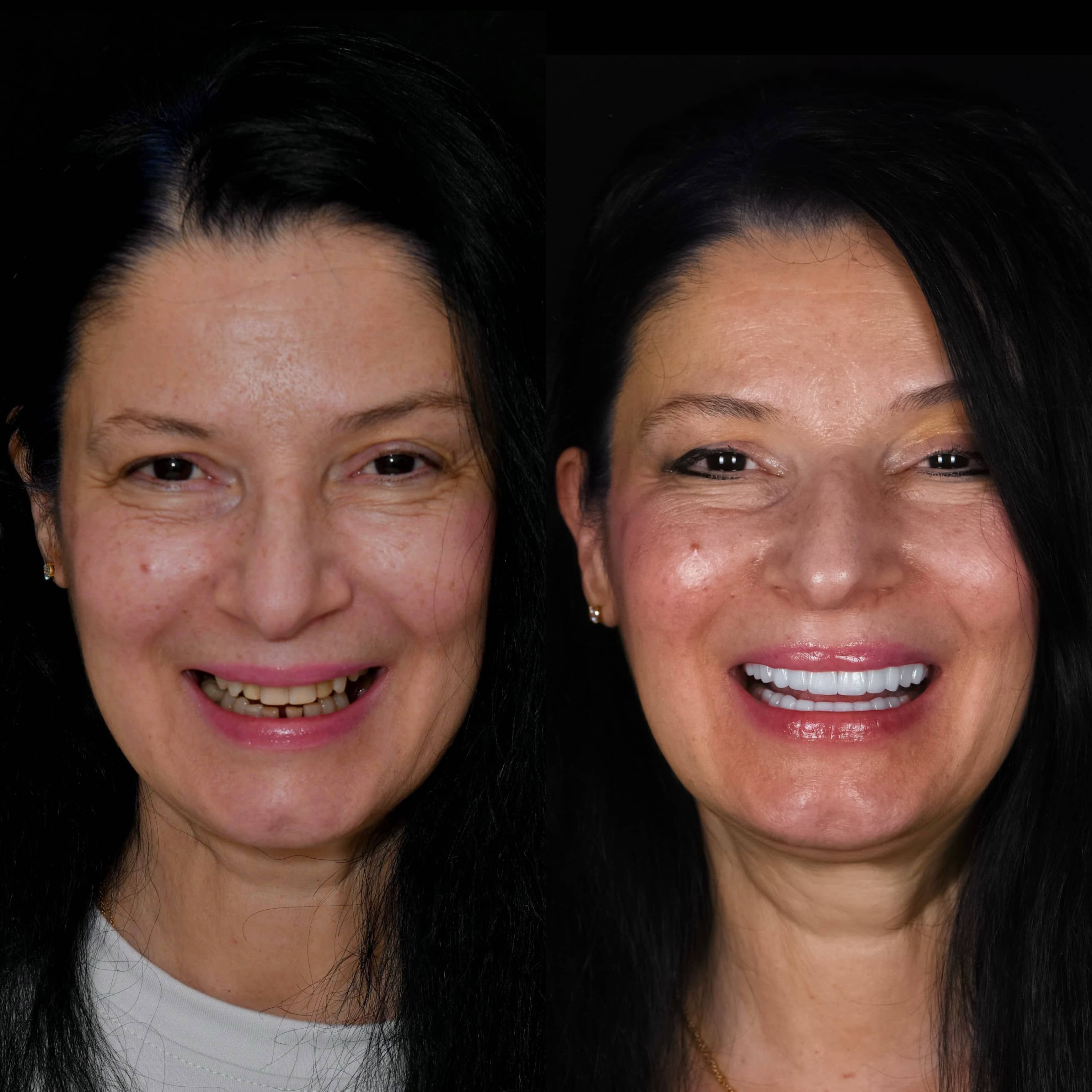 Before and after of veneers procedure by Los Angeles dentist